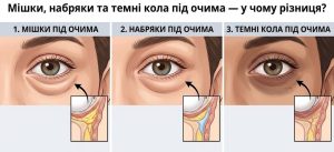 Мішки під очима: як «освітлити» погляд